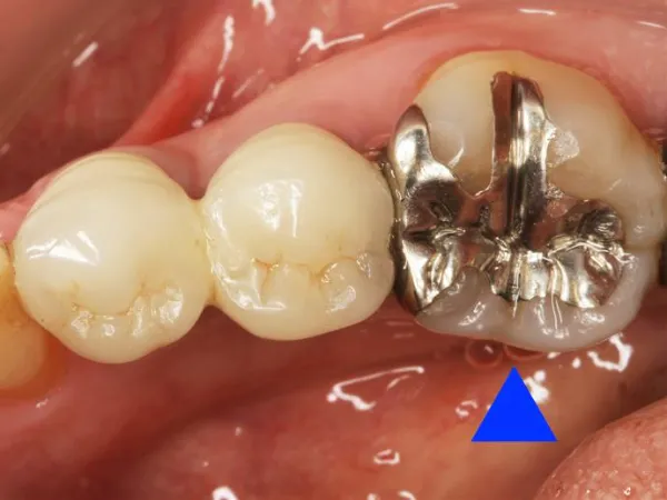西小山歯科クリニックはメタルインレーを用いた治療を行っています