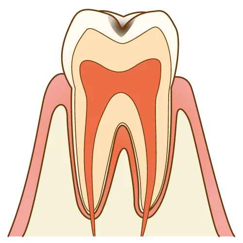 エナメル質が解け始めている状態のイラスト