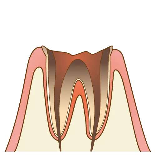 虫歯により神経も死んでしまった状態のイラスト
