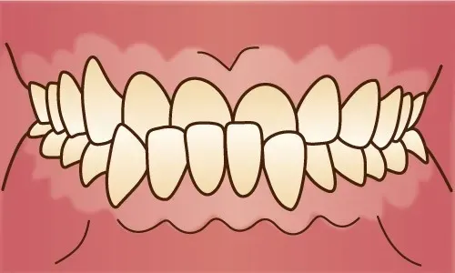 受け口（反対咬合）の症例イメージ