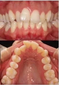 インビザライン治療前の状態です