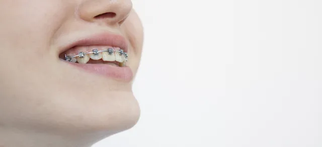 ワイヤー矯正のイメージ