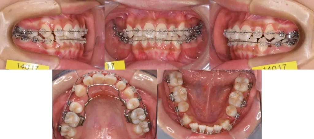 西小山歯科クリニックのワイヤー矯正施術中の状態です