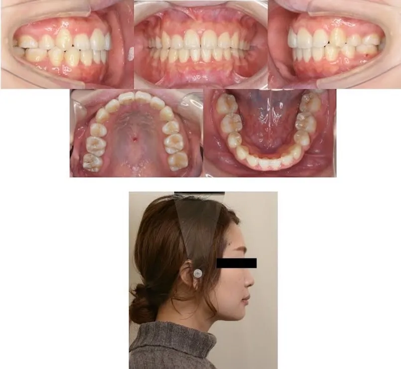 西小山歯科クリニックのワイヤー矯正施術後の状態です