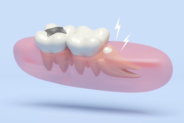 親知らずが痛い時の対処法｜抜歯の流れや費用など解説