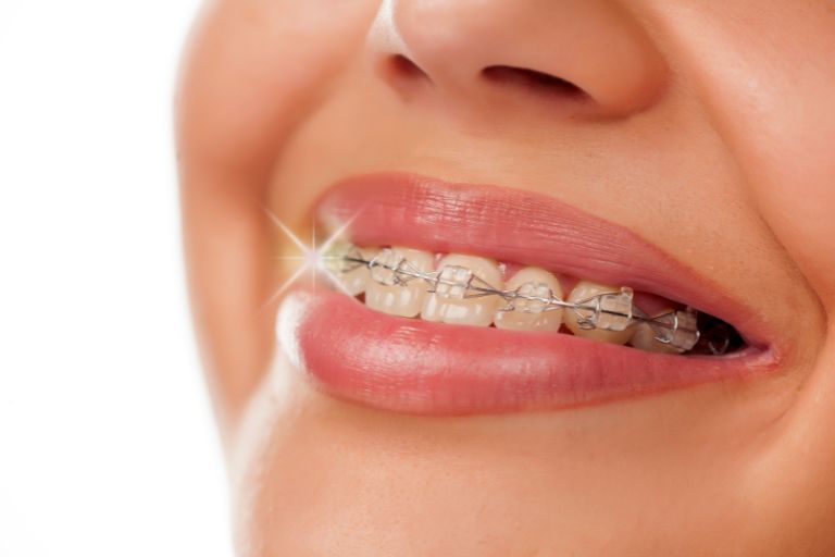  ワイヤー矯正と何が違う？