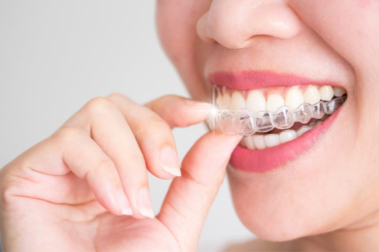 用途で違う!マウスピースの主な種類