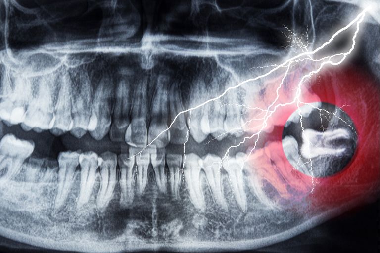 親知らずが痛いときの対処法