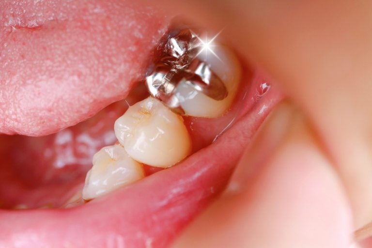 詰め物・被せ物が隠れた口臭の原因になるケースも