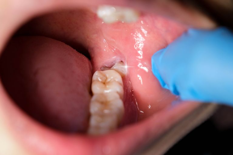 親知らずってどんな歯？